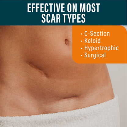 NUVADERMIS Silicone Scar Sheets - Extra Long, Reusable Medical-Grade for C-Section, Tummy Tuck & Surgical Scars
