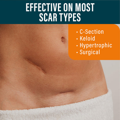 NUVADERMIS Silicone Scar Sheets – Extra Long Medical-Grade Sheets for C-Section, Tummy Tuck, Keloid & Surgical Scars – Pack of 4