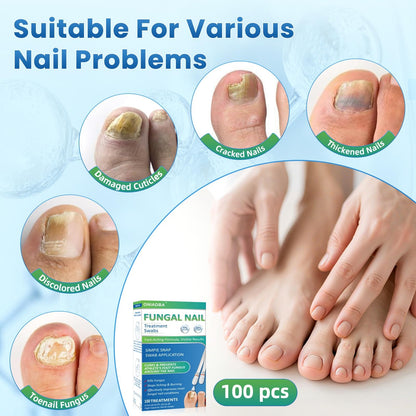 ONIADBA Fungal Nail Treatment Swabs – 100 Ct Extra Strength Toenail & Athlete’s Foot with 25% Undecylenic Acid