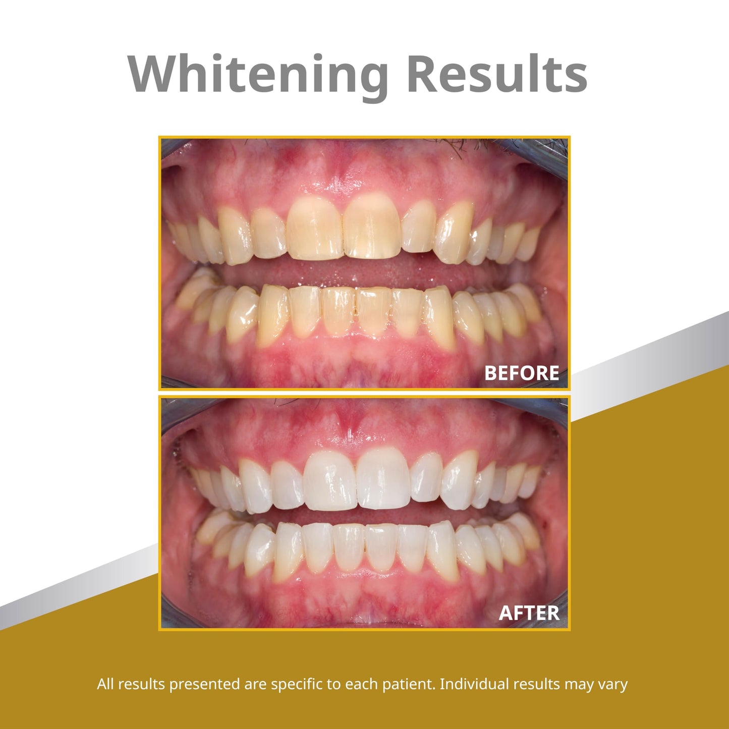 Opalescence 45% Teeth Whitening Gel Refills (12 Syringes) – Mint by Ultradent