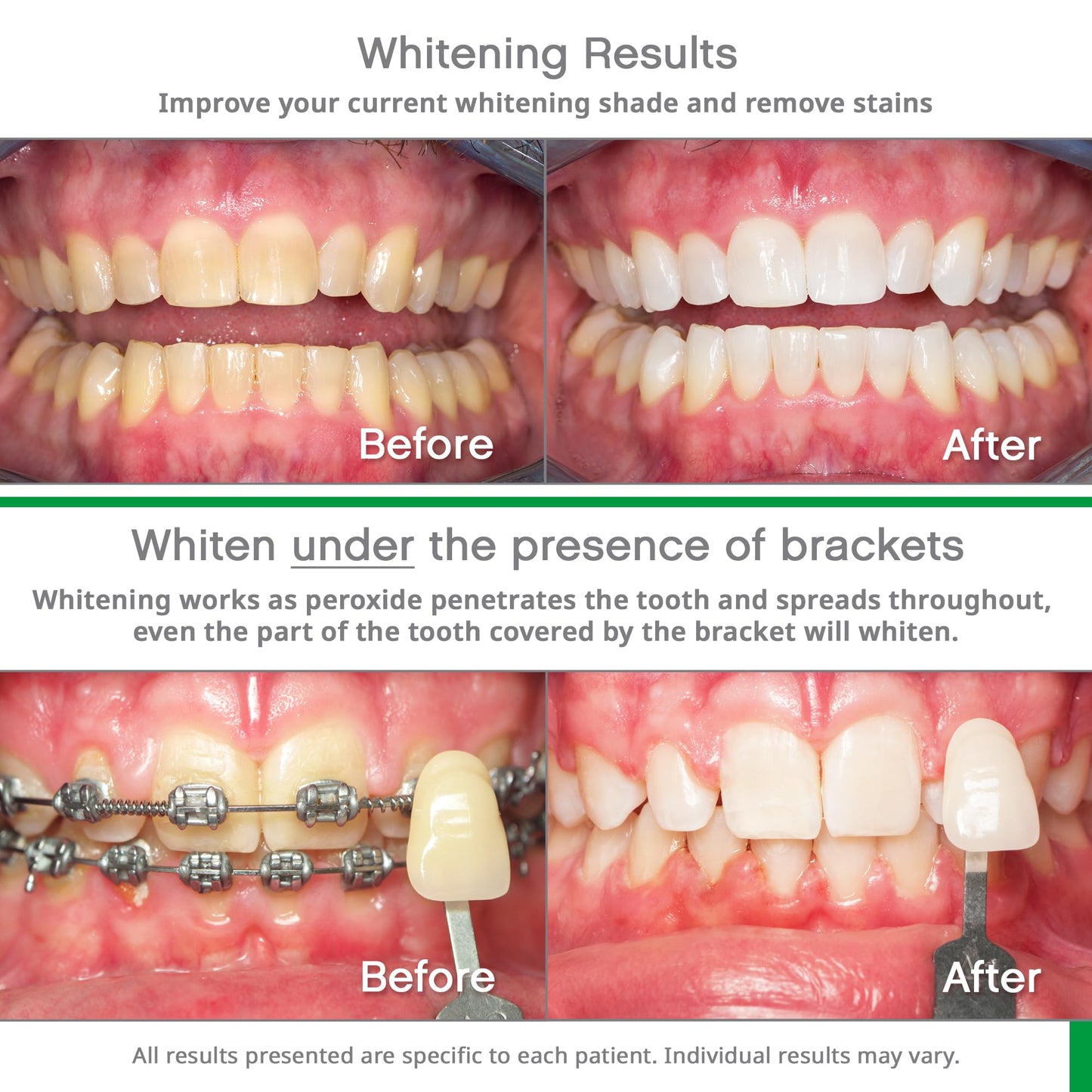 Opalescence Go 10% Mint Teeth Whitening Kit – 10 Treatments GO10-5193-1