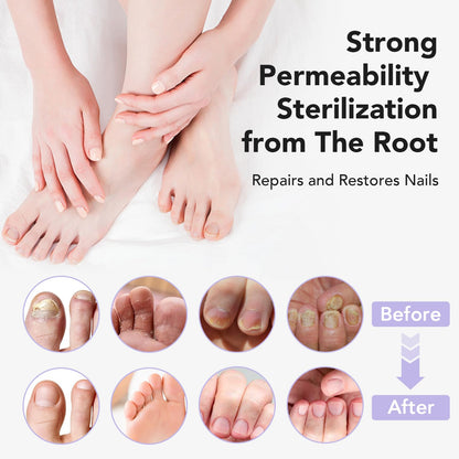 ourui one Toenail Fungus Treatment Extra Strength — 4-Week Nail Repair for Thick, Yellow Nails