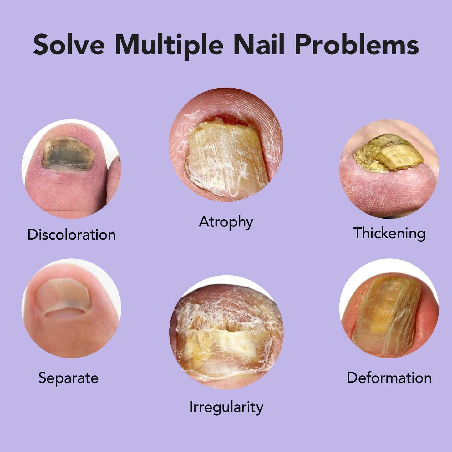 ourui one Toenail Fungus Treatment Extra Strength — 4-Week Nail Repair for Thick, Yellow Nails