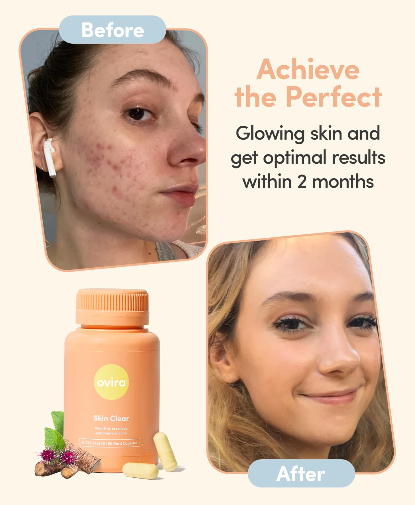 Ovira Skin Clear with ZINCBRIGHT - 60 Capsules for Clear & Glowing Skin | Rosacea & Hormonal Acne Treatment with Vitamin C | Support Collagen Production | Acne Supplements for Women & Men - Pack of 1