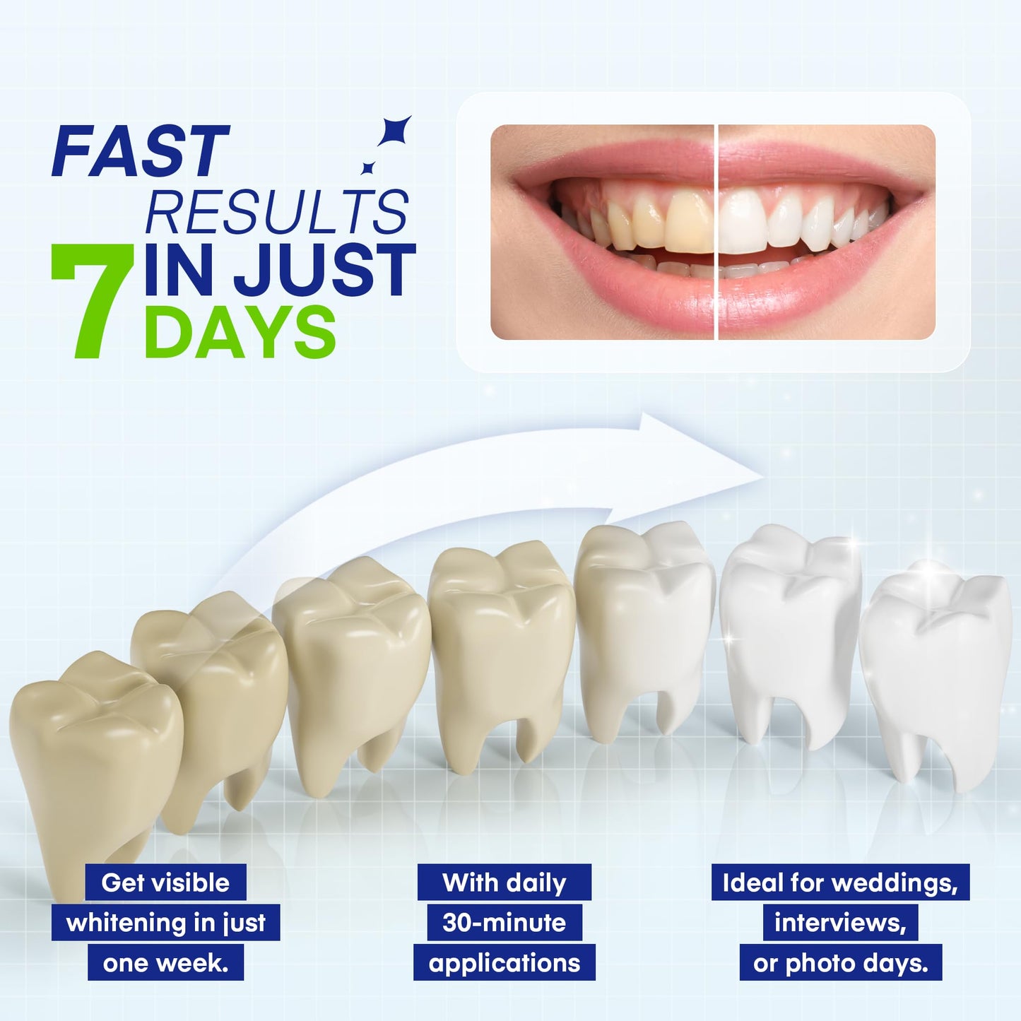 Pearl Smile Teeth Whitening Pen – 5-Pack, 35% Carbamide Peroxide Gel
