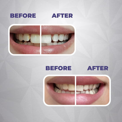 Whitening & Remineralization Strips for Sensitive Teeth – 14 Treatments | Water Dent
