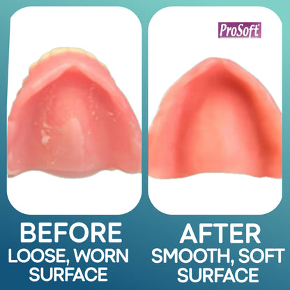 ProSoft Denture Reliner – 2 Denture Plates, Zinc-Free