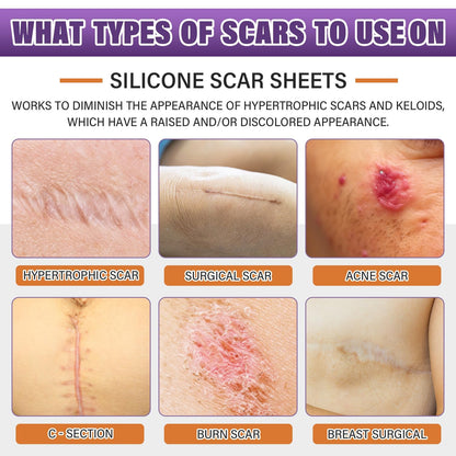 Psecici Silicone Scar Sheets & Tape – Medical-Grade, Reusable Scar Strips (1.6 x 59 in Roll)