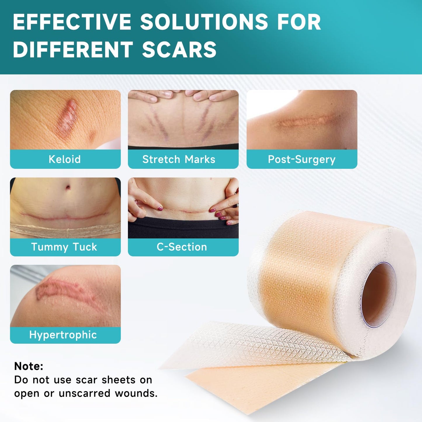 Pumkot Silicone Scar Sheets Roll 1.6in x 120in – Scar Tape for Surgical Scars