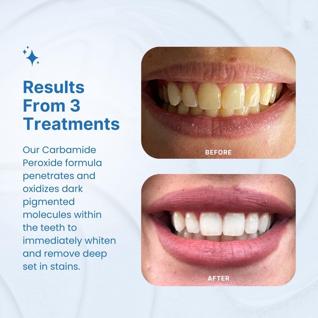 PurelyWHITE DELUXE Teeth Whitening Kit - 15+ Treatments, 7-Minute Results