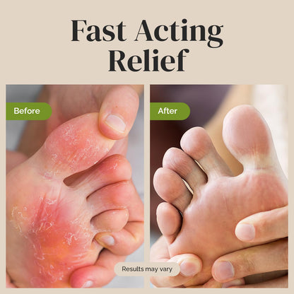 Puriya Clinically Proven Antifungal Cream for Skin Fungus – Extra-Strength Athlete's Foot, Jock Itch, Ringworm Treatment