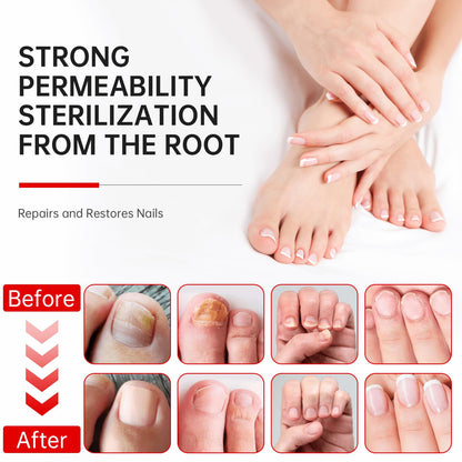 QQE Nail Fungus Treatment Extra Strength - 25% Undecylenic Acid