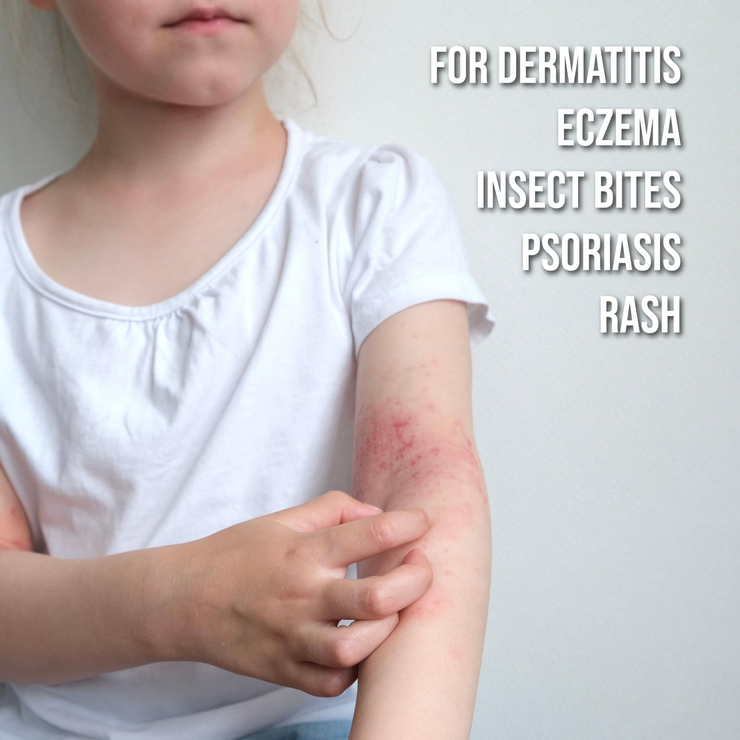quitch Hydrocortisone Healing Balm – Kid-Friendly Eczema & Psoriasis Relief Stick