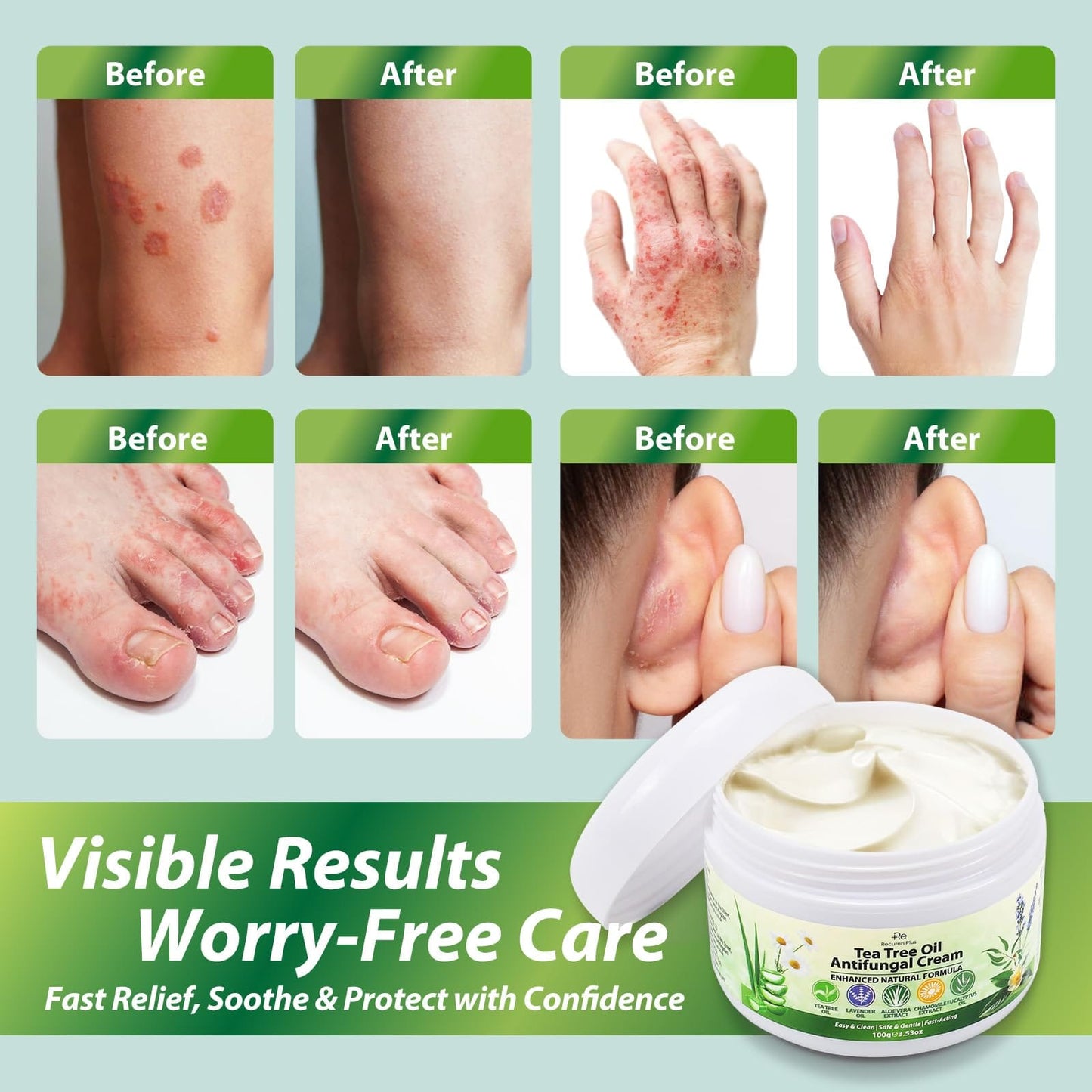 Recuren Plus Antifungal Cream with Tea Tree Oil – Herbal Skin Relief for Fungus, Jock Itch & Athlete's Foot (100g)