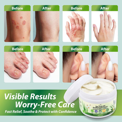 Recuren Plus Antifungal Cream with Tea Tree Oil – Herbal Skin Relief for Fungus, Jock Itch & Athlete's Foot (100g)