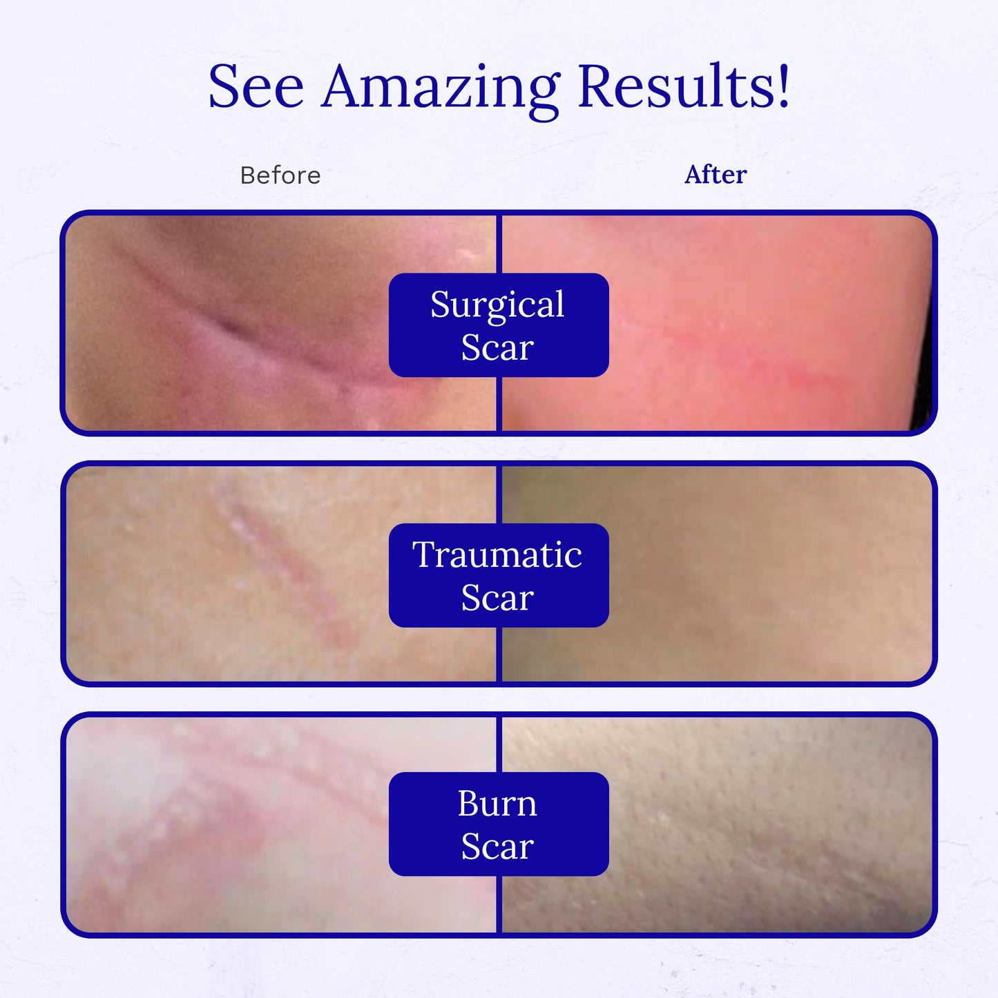 Rejuvaskin RejuvaSil Silicone Scar Gel – 15ml for Surgical Scars, Burns & Acne Scars