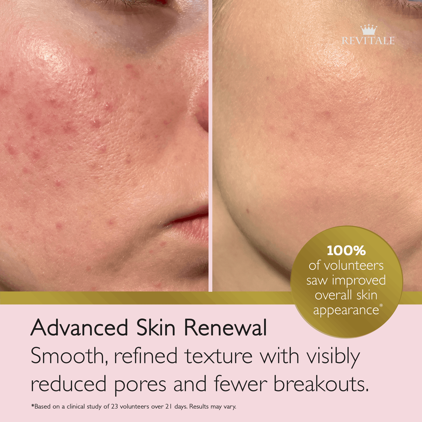 Revitale Advanced Salicylic Acid Cream 80g