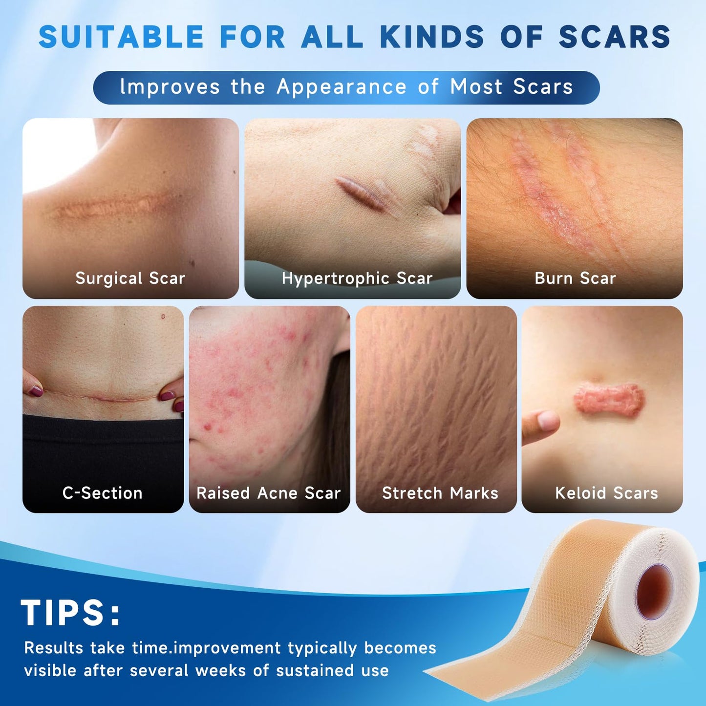 Rvlaim Silicone Scar Sheets – 1.8” x 157” Roll for Surgical Scars, Keloids, Stretch Marks
