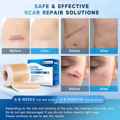 Rvlaim Silicone Scar Sheets – 1.8” x 157” Roll for Surgical Scars, Keloids, Stretch Marks