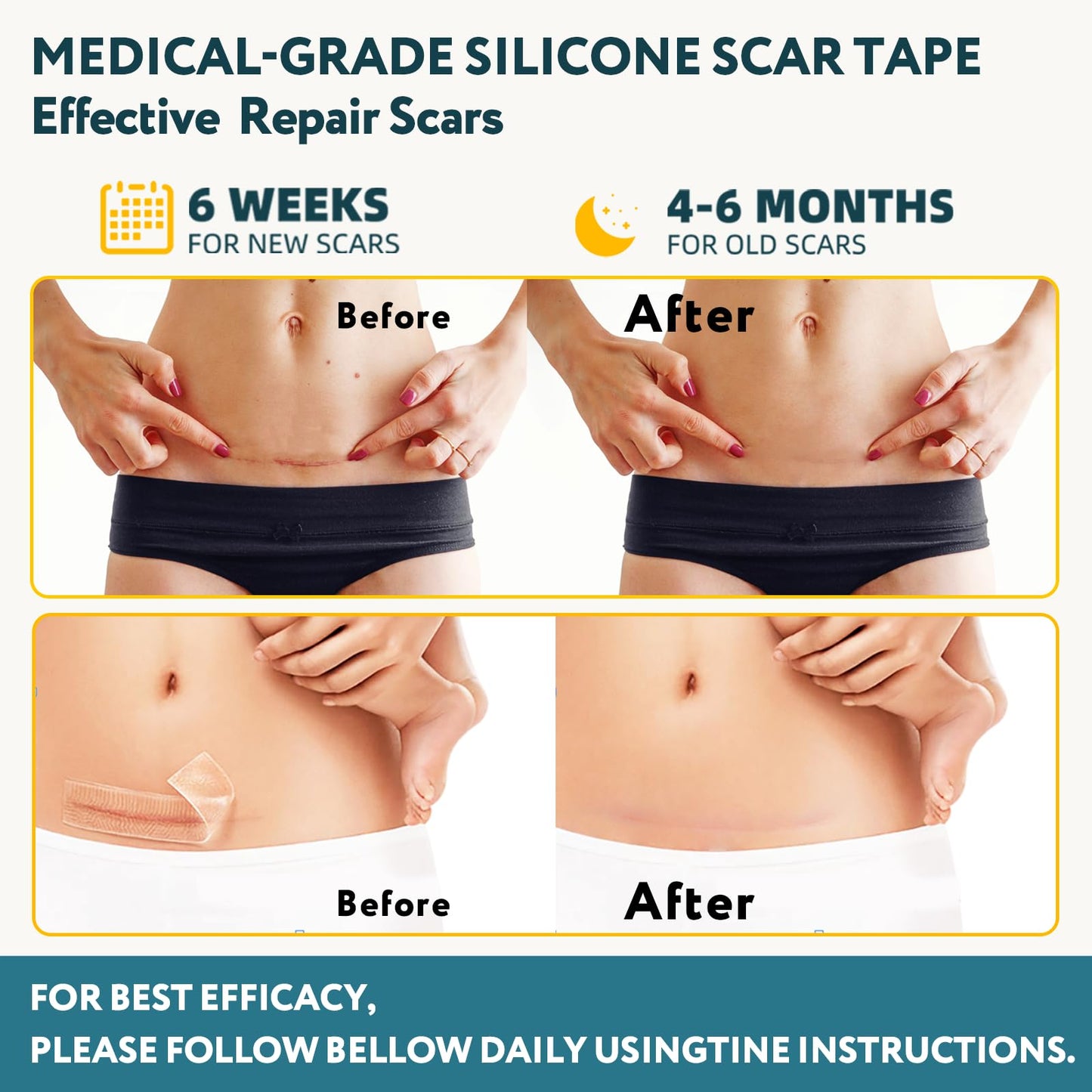 RWT Silicone Scar Sheets – 60 inch x 1.6 inch Roll for Surgical Scars