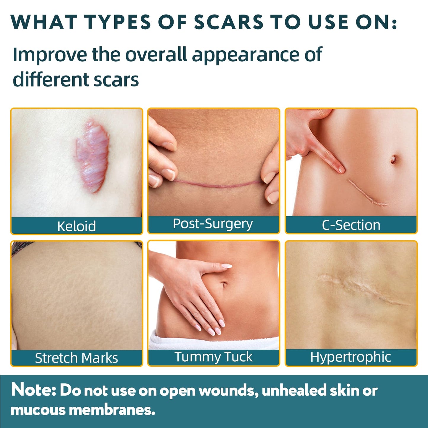 RWT Silicone Scar Sheets – 60 inch x 1.6 inch Roll for Surgical Scars