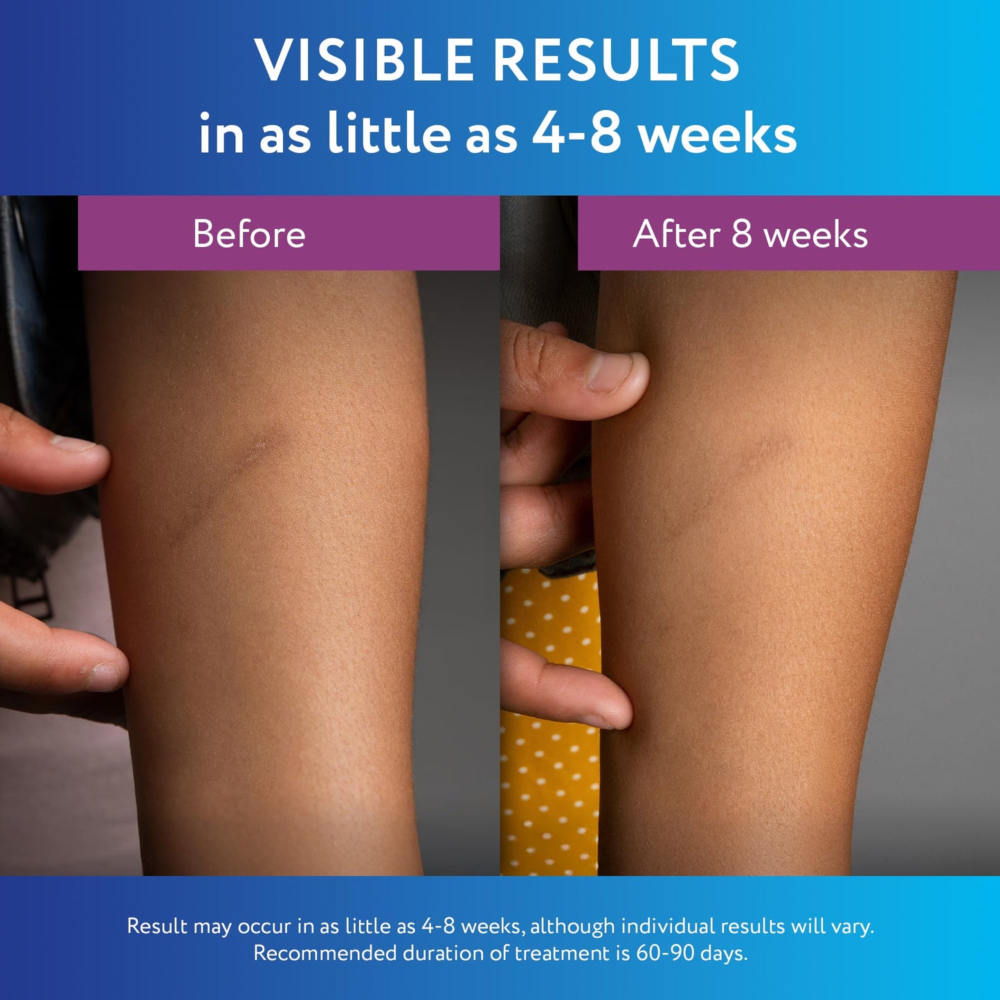 ScarAway Silicone Scar Gel - Improve Scar Size, Color & Texture | Water-Resistant 20g