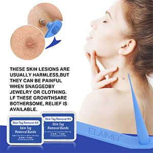SHISUIZHE Skin Tag Remover – FDA-Cleared At-Home Skin Tag Removal Kit