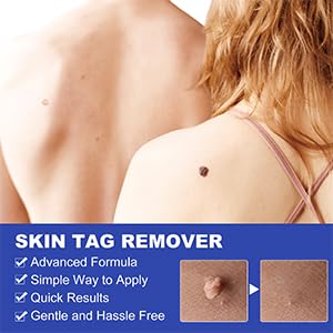 SHISUIZHE Skin Tag Remover – FDA-Cleared At-Home Skin Tag Removal Kit