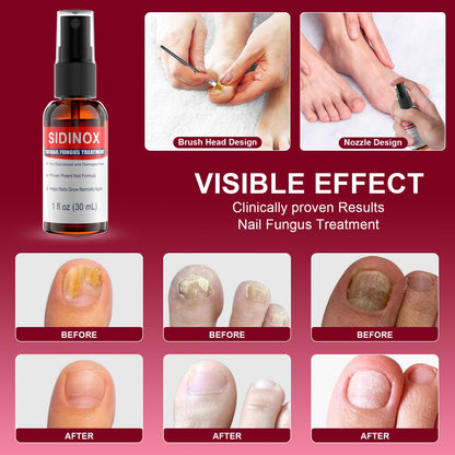Sidinox Toenail Fungus Treatment Extra Strength with 25% Undecylenic Acid — 5 Pack