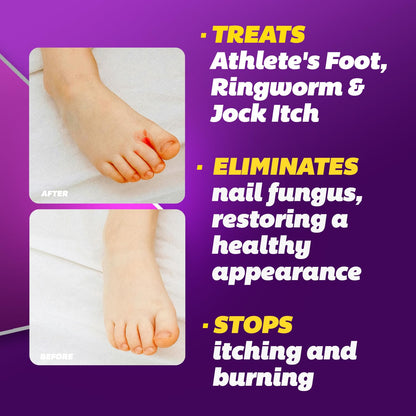 Silka Max Strength Antifungal Liquid & Cream Set – Fast Relief for Toenail Fungus, Athlete's Foot & Ringworm