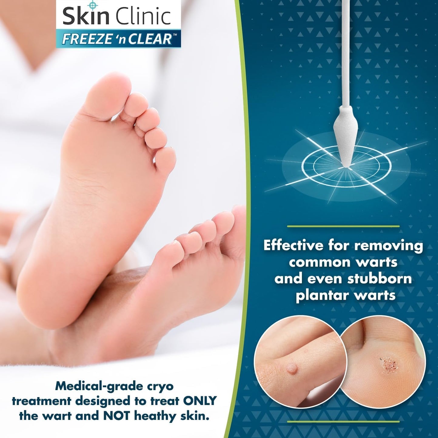 Skin Clinic Freeze 'n Clear Advanced Wart Remover — USA-Made Cryo-Freeze Kit with 12 Precision-Tip Applicators | FDA-Cleared