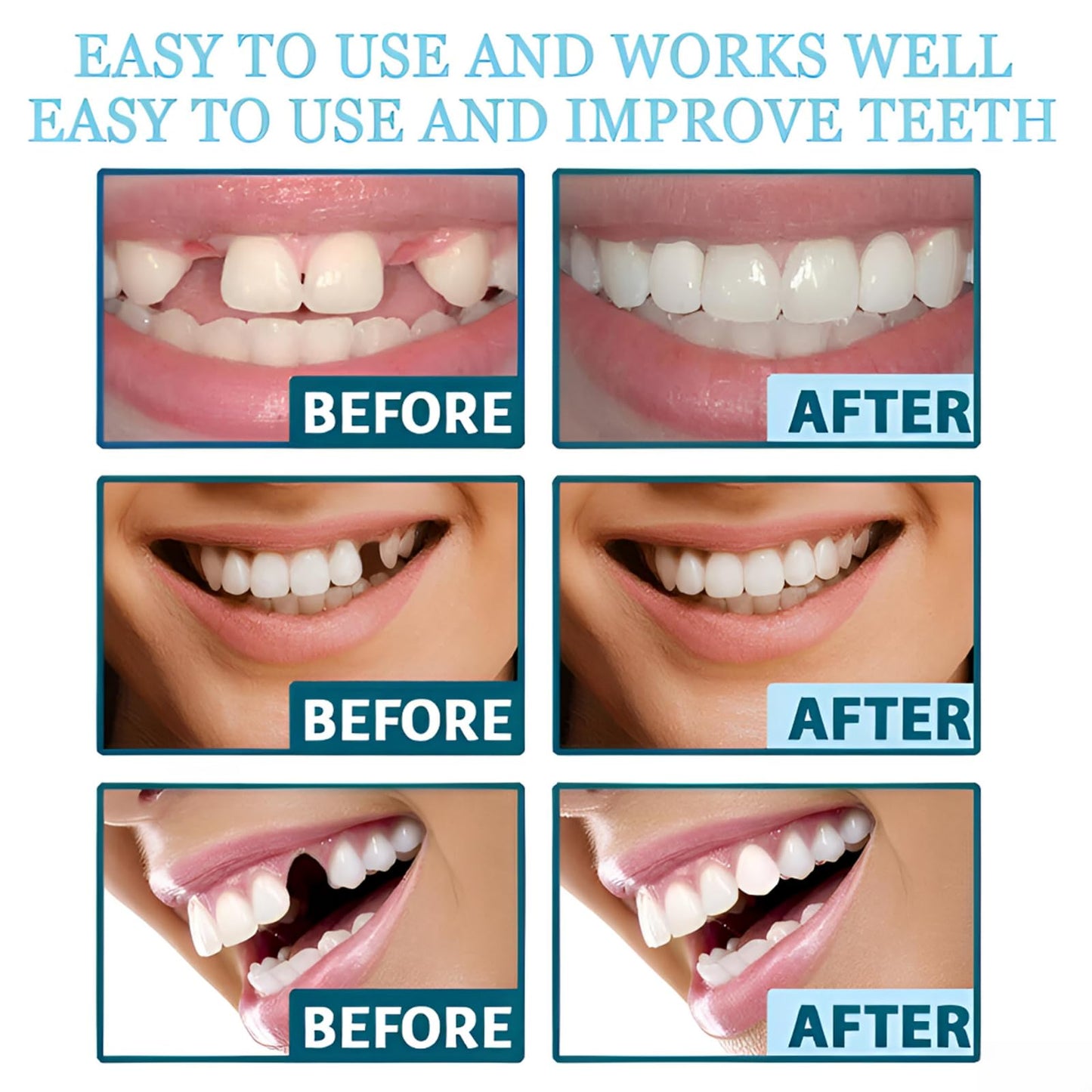 2 Pairs of Beautiful Smiles – Upper & Lower Teeth Set (Temporary Use)