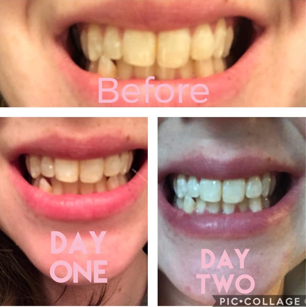 Smile Titan Teeth Whitening Kit with LED Light - 3% Carbamide Peroxide (5-Piece Set)