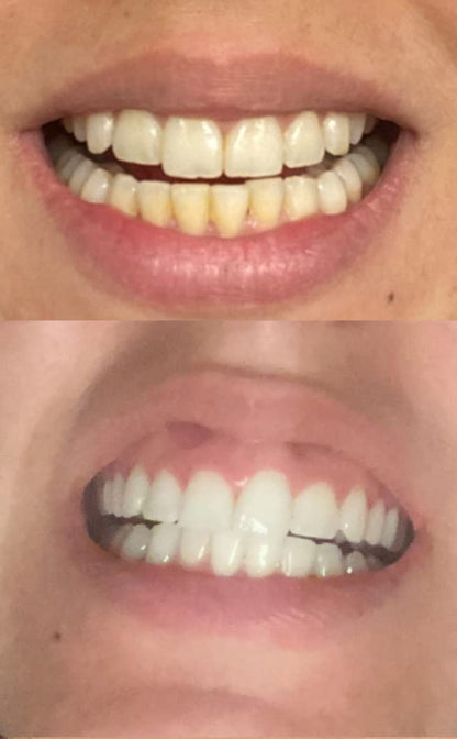 Smile Titan Teeth Whitening Kit with LED Light - 3% Carbamide Peroxide (5-Piece Set)