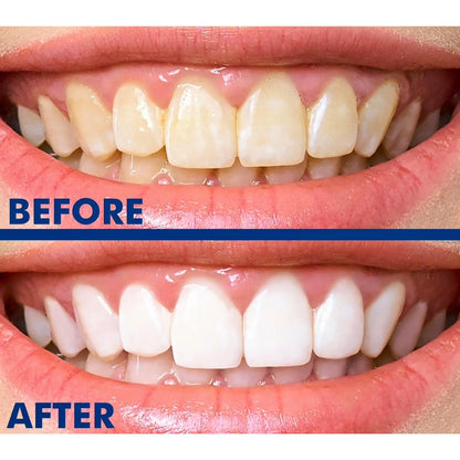 SmileWhite Teeth Whitening Pen 4 Pack – No Sensitivity, Enamel Safe, Fast Whitening with Natural Mint