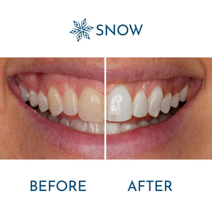 Snow Extra-Strength Teeth Whitening Serum – Whitening Pen with Potassium Nitrate & Hydroxyapatite – 1 Pack