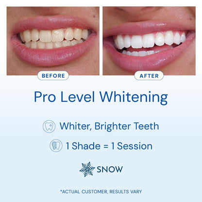Snow Teeth Whitening Kit with LED Mouthpiece, Hydroxyapatite Serum, 3 Wands – Wireless Whitening Kit (6 Months)