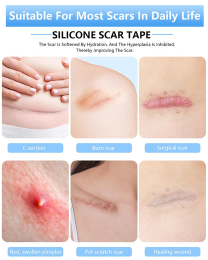 Somlzu Silicone Scar Sheets | 1.6 x 60 Inch Medical Grade Roll (1.5M)