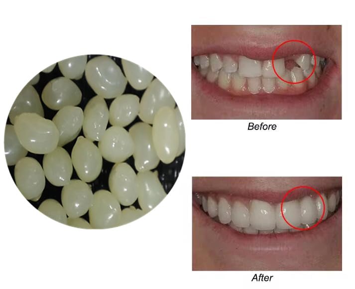 Sowsmile 4-Color Temporary Moldable Teeth Repair Beads Kit