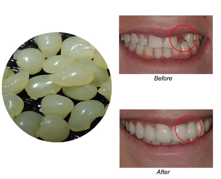 Sowsmile 4-Color Temporary Moldable Teeth Repair Beads Kit