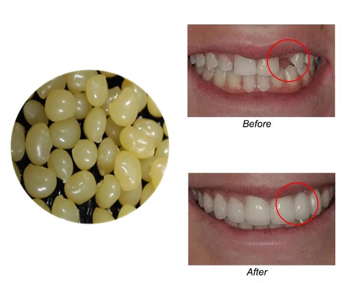 Sowsmile 4-Color Temporary Moldable Teeth Repair Beads Kit