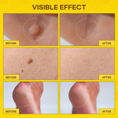 SupreH Fast-Acting Bee Venom Wart Remover – Freeze Off for Plantar & Genital Warts, 18 ml