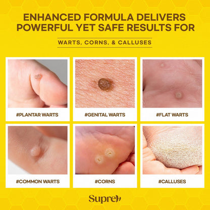 SupreH Fast-Acting Bee Venom Wart Remover – Freeze Off for Plantar & Genital Warts, 18 ml