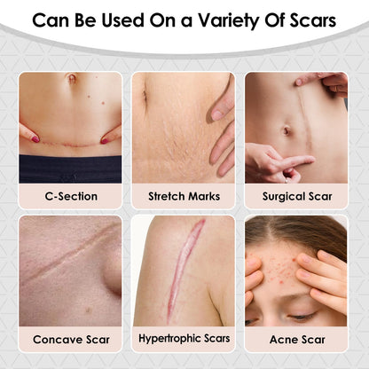 SWturK Silicone Scar Sheets Roll – Medical-Grade Scar Tape for Surgical Scars, C-Section, Tummy Tuck (1.6-in x 60-in)