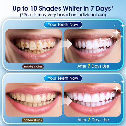 Teeth Whitening Kit – 3 Pens + 2 Desensitizing Pens | LED Light, 35% Carbamide Peroxide