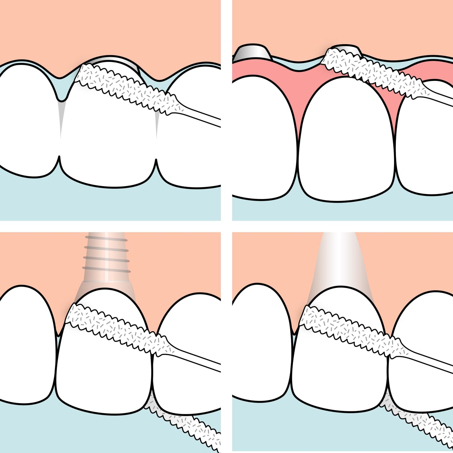 TePe Bridge & Implant Floss for Implants, Bridges & Braces – 30 Pieces