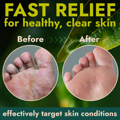 Foot Cream with Tea Tree Oil | Antifungal Foot Care by Terramed Just Think Comfort | 4.05 fl oz