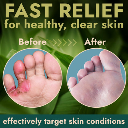 Tea Tree Oil Antifungal Foot Gel | Terramed Just Think Comfort | No-Touch Applicator | 1-Week Option