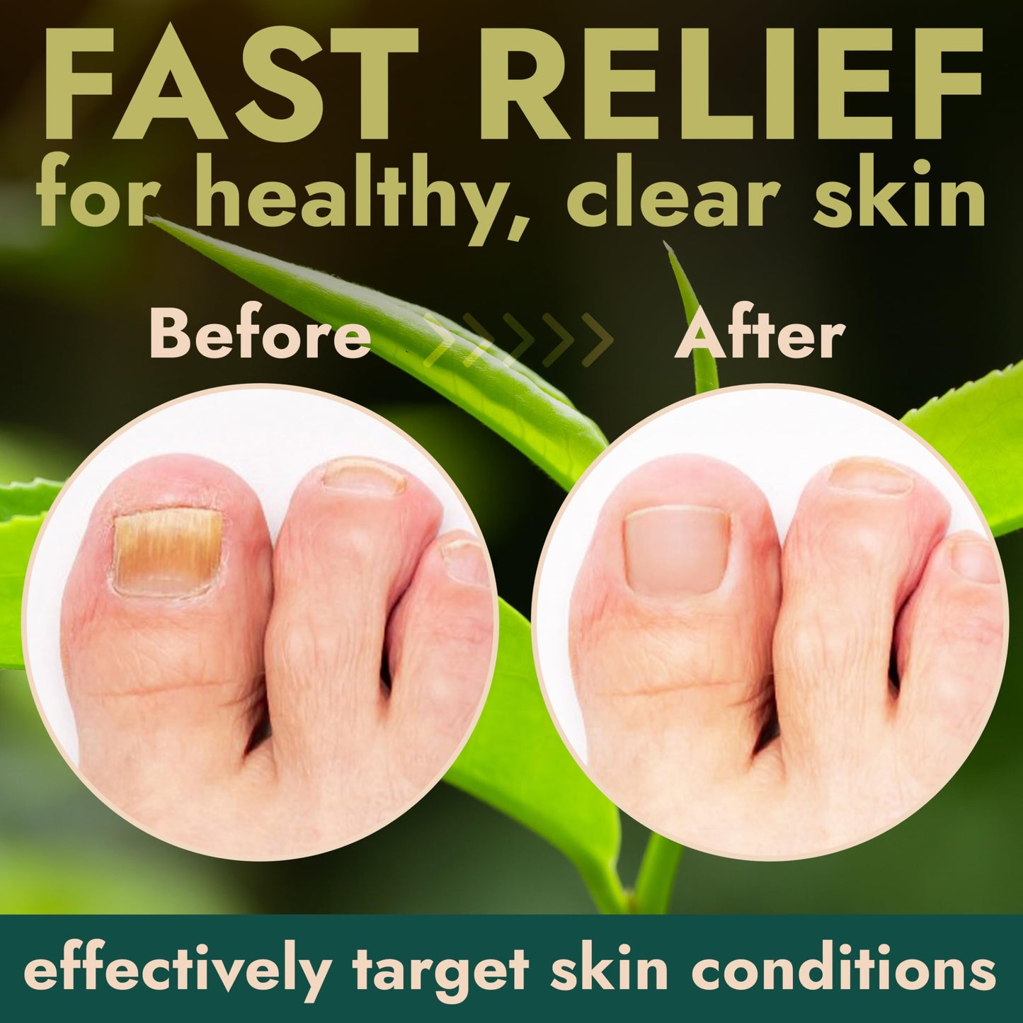 Terramed Just Think Comfort Toenail Fungus Pen — Tea Tree Oil, Fast-Acting, No-Touch Applicator (20ML)