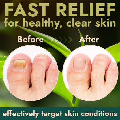 Terramed Just Think Comfort Toenail Fungus Pen — Tea Tree Oil, Fast-Acting, No-Touch Applicator (20ML)